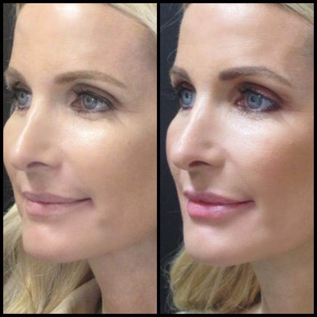 Juvederm lip filler - Things You Should Know Before Getting Lip Filler